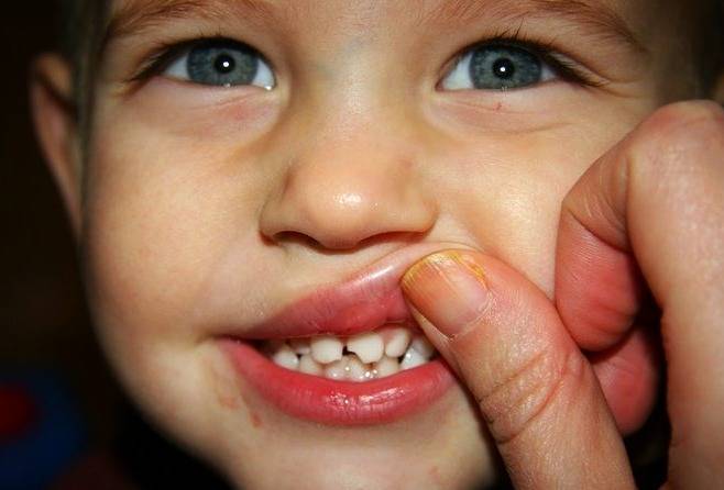 لب پریدگی دندان کودک