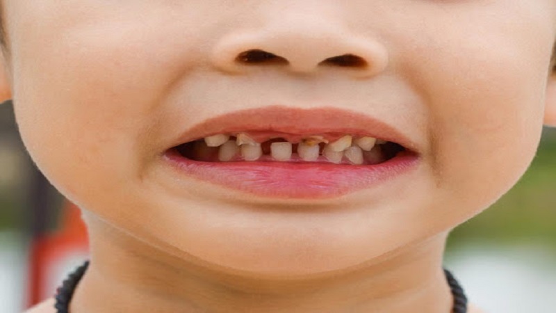 دلیل و مسئله ای مهم درباره تغییر رنگ دندان کودک